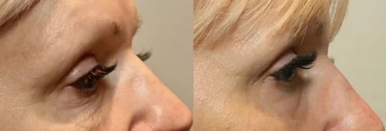 Morpheus8 Before & After