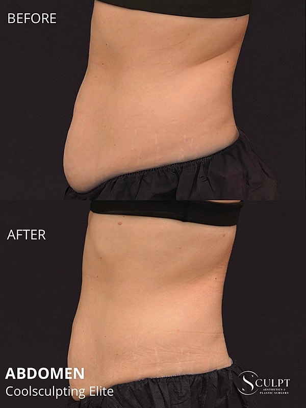 Coolsculpting Elite Before & After