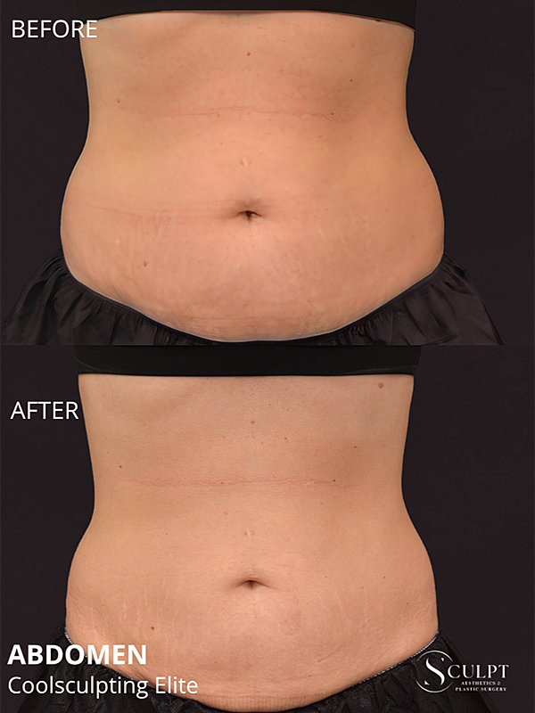 Coolsculpting Elite Before & After
