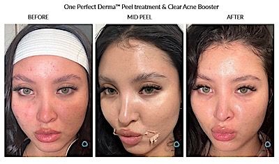 Perfect Derma Peel Before & After