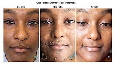 Perfect Derma Peel Before & After