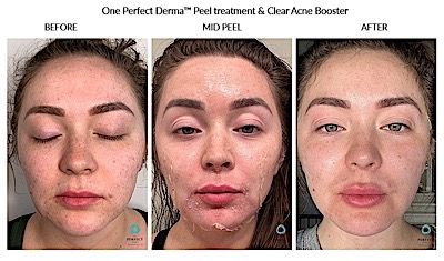 Perfect Derma Peel Before & After