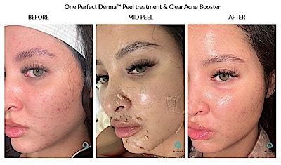 Perfect Derma Peel Before & After