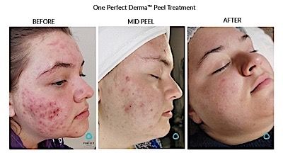 Perfect Derma Peel Before & After