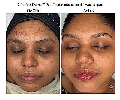 Perfect Derma Peel Before & After