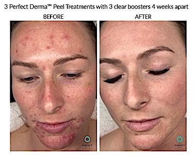 Perfect Derma Peel Before & After