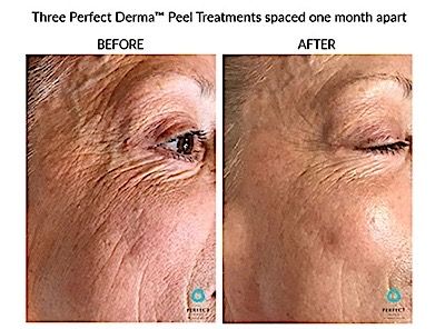 Perfect Derma Peel Before & After