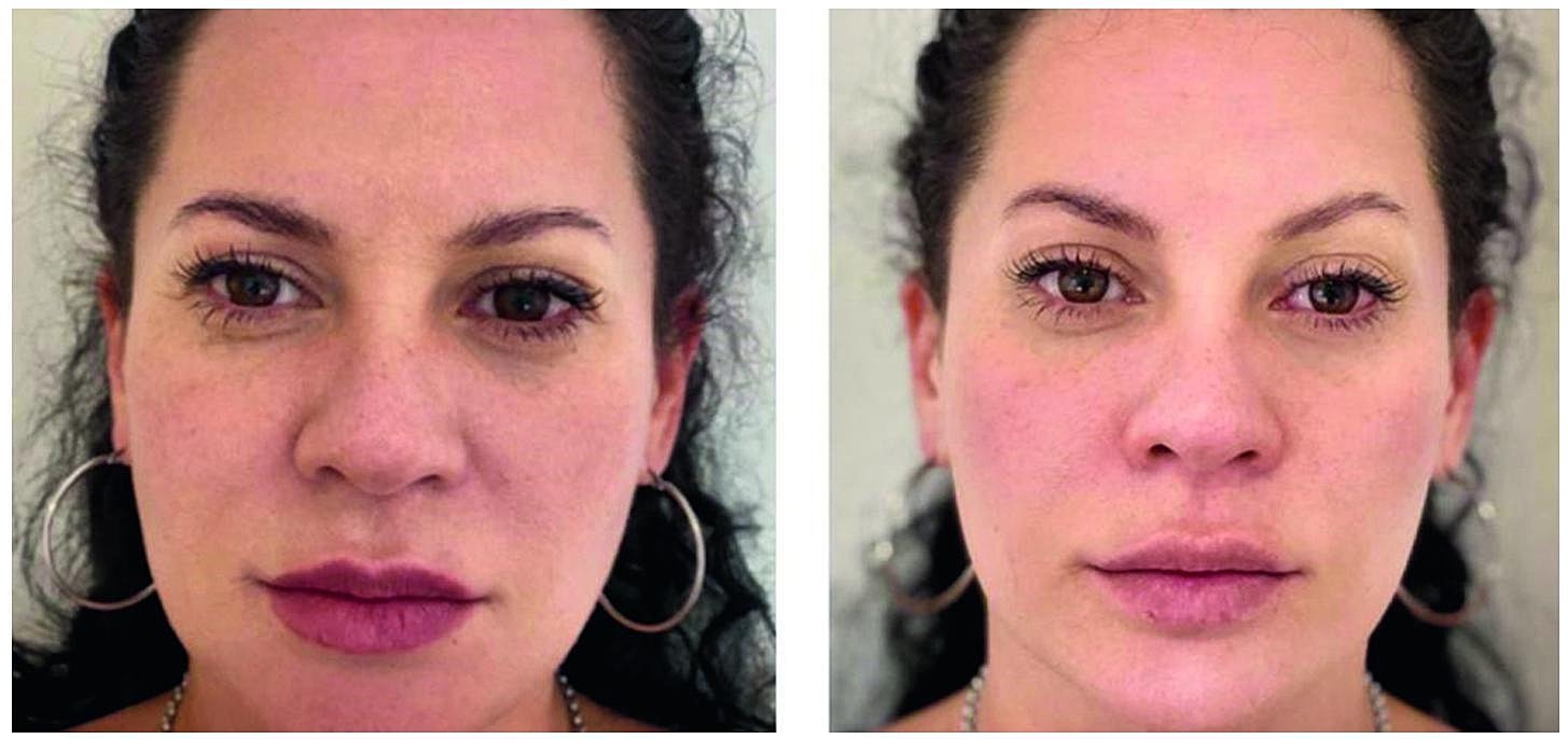Fotona4D Laser Before & After