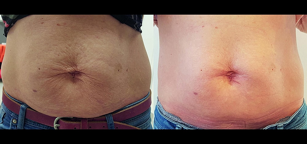 Fotona4D Laser Before & After