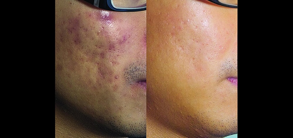 Fotona4D Laser Before & After