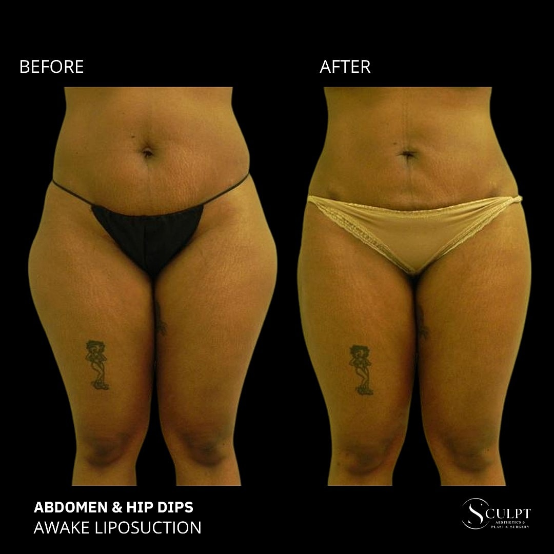 Liposuction Before & After